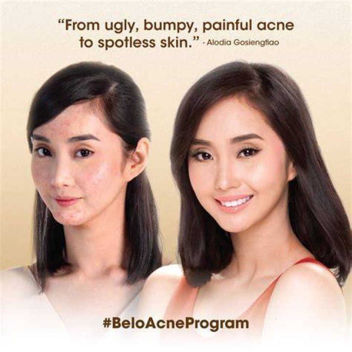 Alodia Gosiengfiao Before Operation and Surgery Photos On Instagram, FHM Cover Girl Looked Different ·