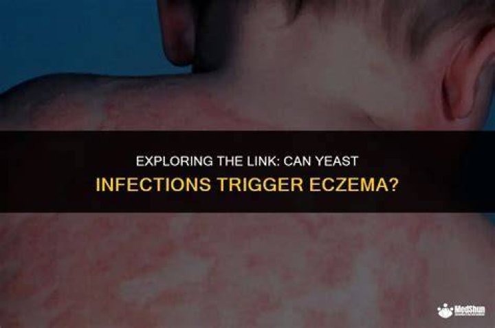 Can Lume Deodorant Trigger Yeast Infections?