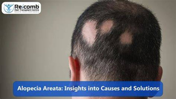Discoveries And Insights Into Alopecia And Confidence