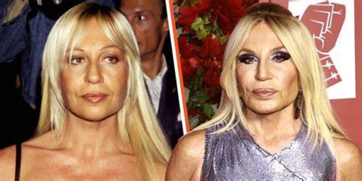 donatella versace a before and after Celebrity plastic surgery