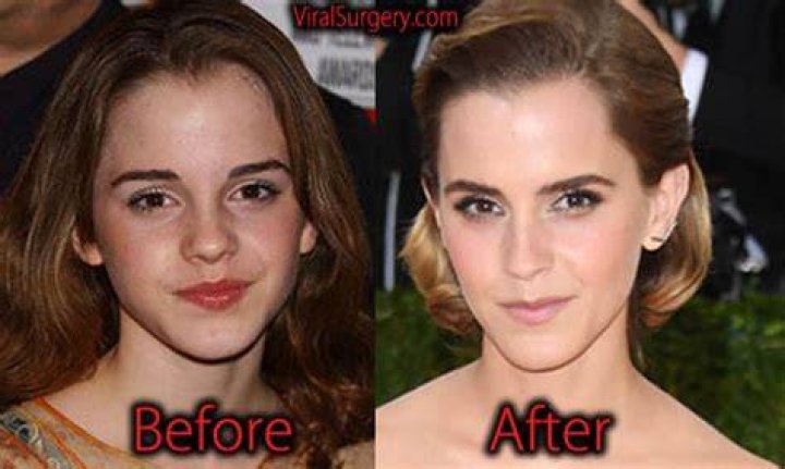Emma Watson's Nose Surgery Journey