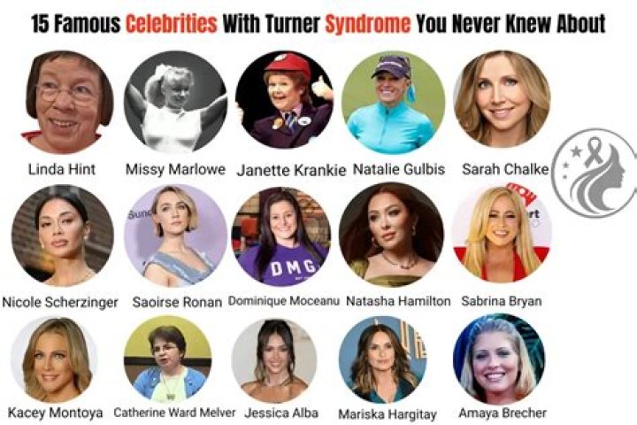 Famous Figures With Turner Syndrome