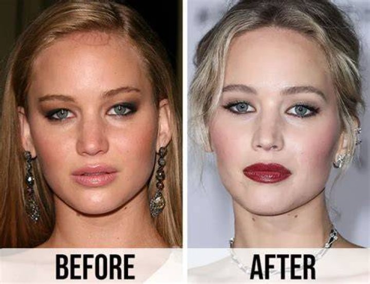 Jennifer Lawrences Plastic Surgery: Rumors and Reality