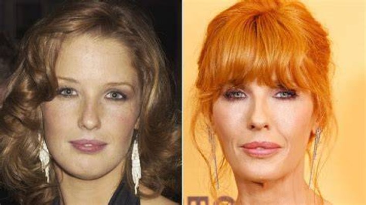 Kelly Reilly's Lips, Teeth, And Plastic Surgery