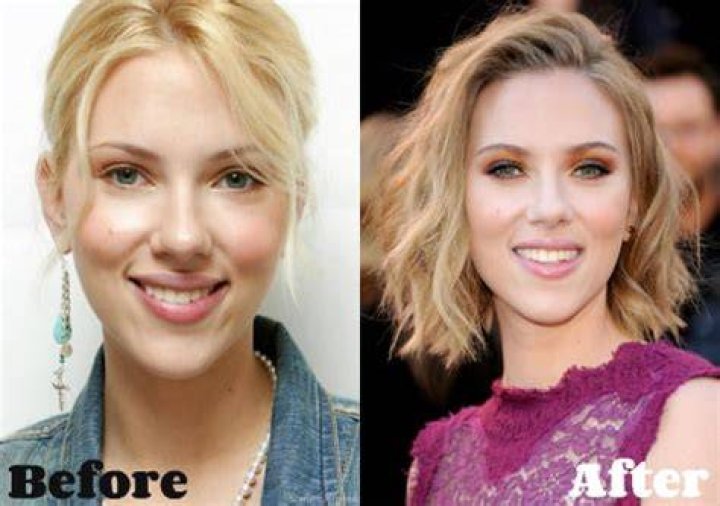 Scarlett Johansson Breast Reduction Plastic Surgery Before and After