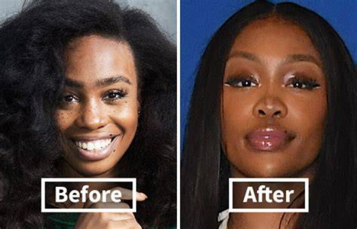 SZA's Journey Before Plastic Surgery