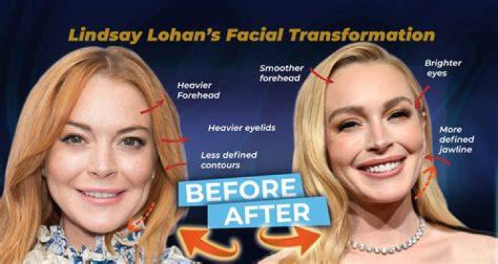 Unveiling Lindsay Lohan's Facelift Journey: Insights And Revelations