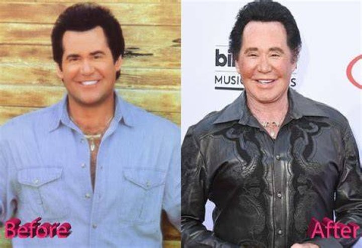 Wayne Newton Plastic Surgery A Las Vegas Facelift